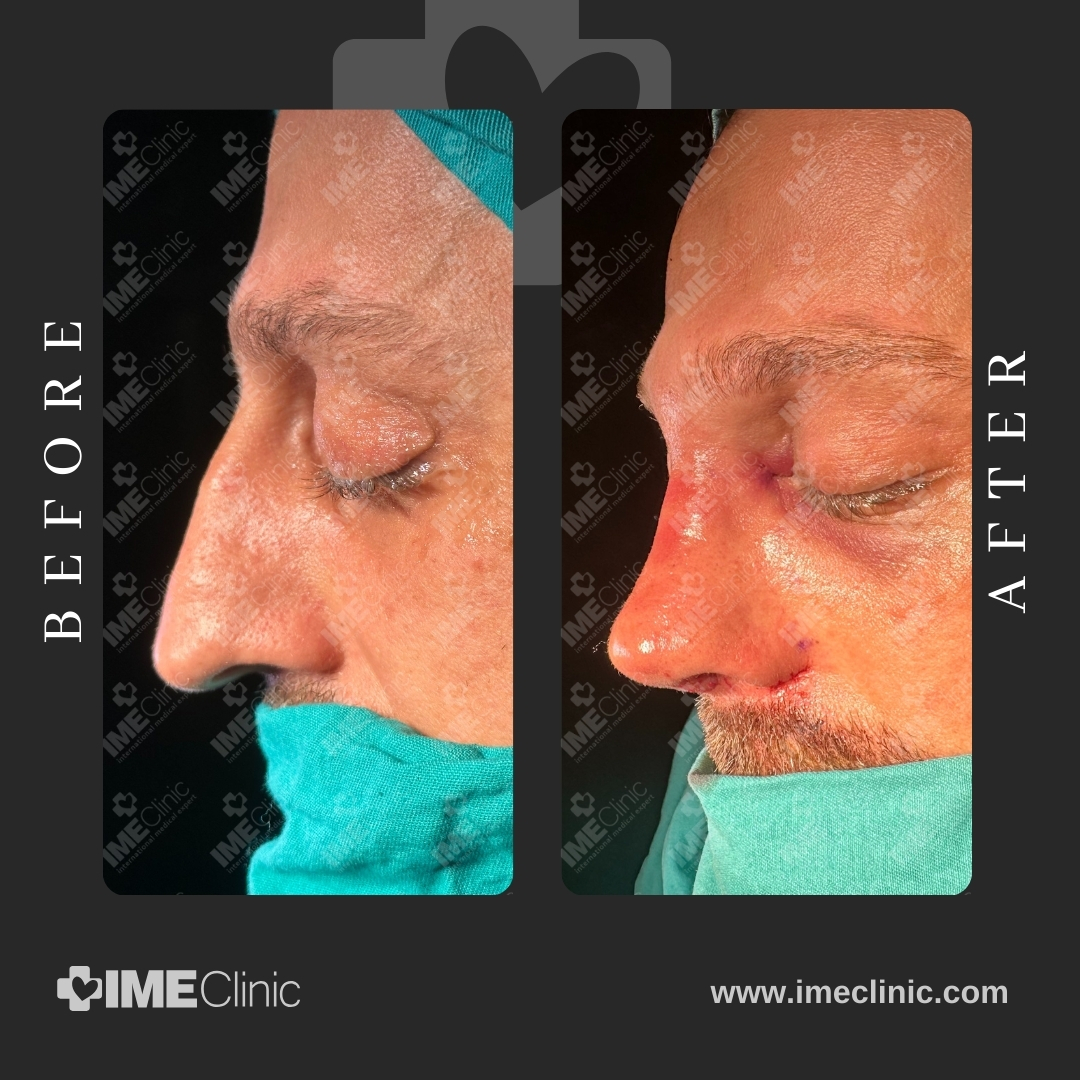 
                                     Side-by-side images of a persons face before and after a rhinoplasty procedure. The Before image shows the noses original shape, and the After image displays changes post-surgery. The person wears a head covering and mask.